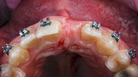 Upper jaw without a central tooth with braces, view through the mirror