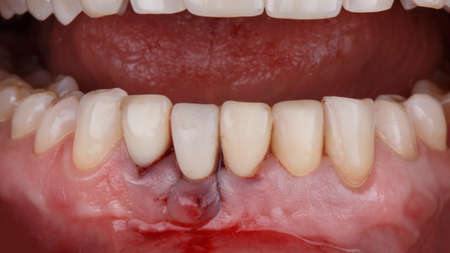 installed temporary dental crown in the lower jawの写真素材