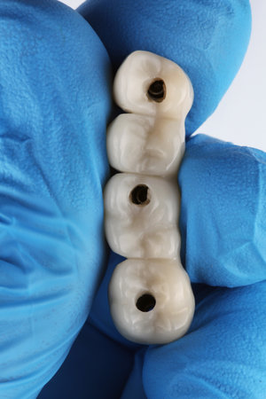 dental bridge for four teeth made of plastic in the doctor's hand on a white background, view of the morphologyの写真素材
