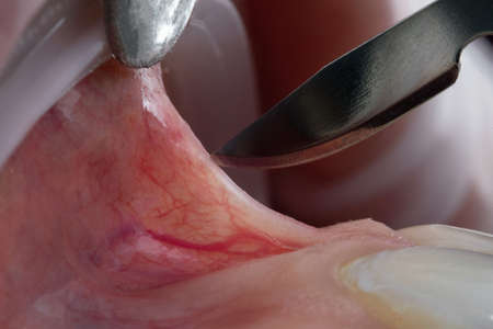 macro photo of a dental scalpel next to the frenum of the upper jaw