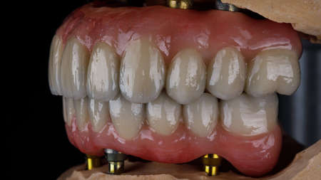 two dental prostheses of the upper and lower jaws in bite on plaster models
