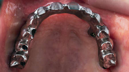 titanium bar of the upper jaw in occlusion. one of the stages of creating a prosthesisの写真素材