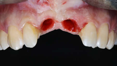 gums after implantation before placing the two central teeth