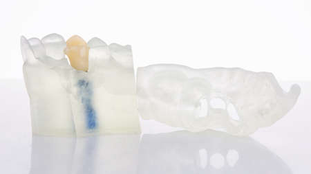 temporary single dental crown on a special model and a surgical template for implant placement on a...