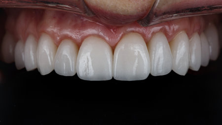 ceramic veneers on the upper jaw in the patient's oral cavity with a black backgroundの写真素材
