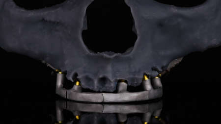 model of a resin skull with a dental bar in chrome cobalt on a black background