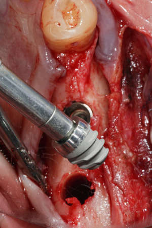 mini dental implant before insertion into the bone