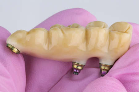dental bridge for four chewing teeth with natural shades in a pink glove