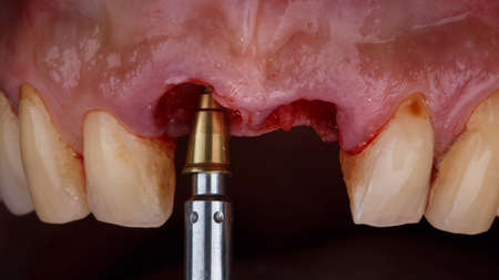 Moment Installing the Contemporary Dental Abatment for Installing Coron Correct