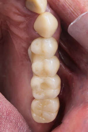 Mounted Dental Bridge Prosthesis of ceramics in the oral patient in the chewing area