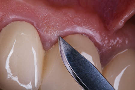 Beautiful frame Dental scalpel and gums in front of surgery manipulation