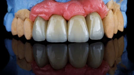 four high quality dental crowns after implantation, shot on black glass with reflectionの写真素材