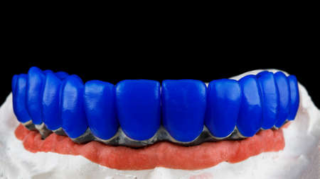 wax teeth on titanium beam with dental model and pink gumの写真素材