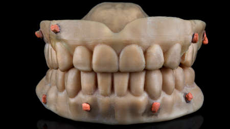 dental dental prostheses with special markers for the lower and upper jaws in the bite on a black...