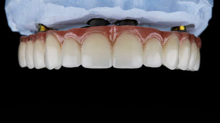 Dental prosthesis of the upper jaw with a pink gum on a model of plaster, shot on a black backgroundの写真素材