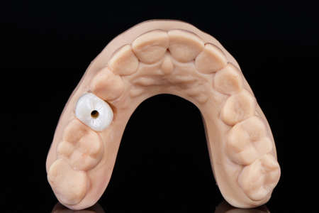 dental crown made of zircon on a special dental model for precision execution, shot on a black...