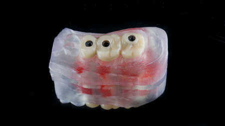 crowns from three teeth on a special dental model from a 3D printer on a black background