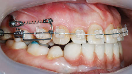 complex brace system for smoothing the patient's bite
