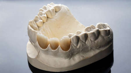 beautiful composition of dental crowns of the front incisors on a model of plaster, shot on a light...