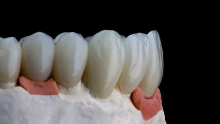 aesthetics of dental veneers for central incisors on a black backgroundの写真素材