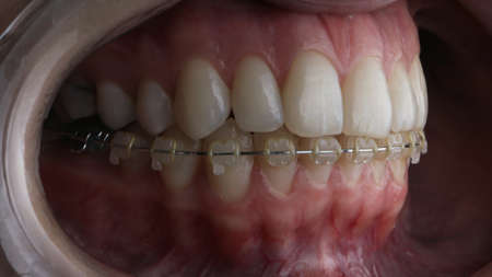 patient's lower jaw braces, filmed with artistic soft light