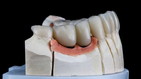 dental crown with artificial gum on the model of the lower jaw on a black background