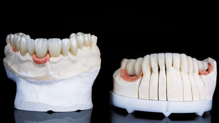 photograph of dental veneers and crowns on special dental models, shot on a black background