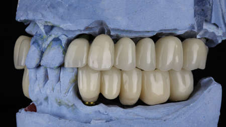 dental bridges on plaster models, for prosthetics of all jaws