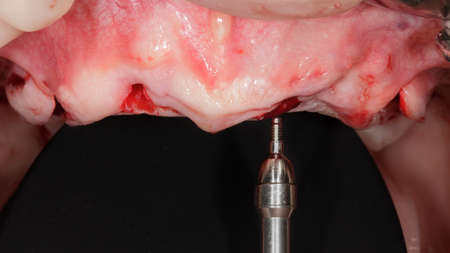 gingival cavity of the upper jaw and dental multi-unitの写真素材