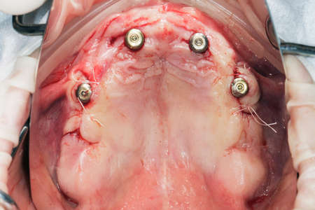 the gum cavity of the patient's upper jaw after four installed implants with suturing and gingiva...