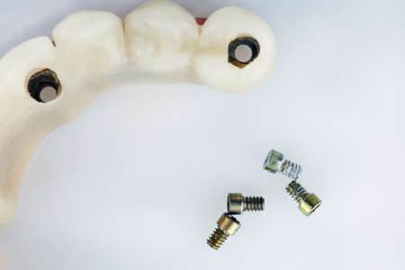 special dental bolts for fixing a temporary prosthesis on a white backgroundの写真素材