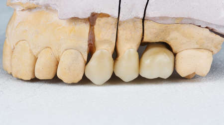 dental crown on a plaster model, filmed on a white background