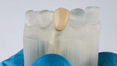 temporary crown on a model of the jaw made on a 3D printer, filmed on a white backgroundの写真素材