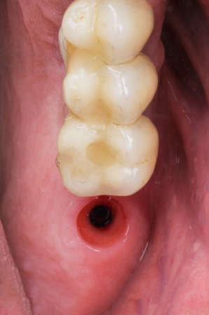 socket in the gum before installing a kemic crown