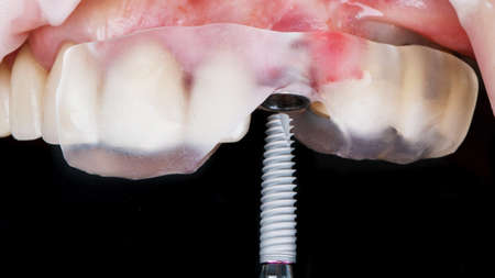 dental implant before insertion through a surgical template for accuracyの写真素材