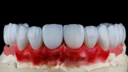 aesthetics of ceramic veneers of the upper jaw on a plaster model, photo against a black backgroundの写真素材