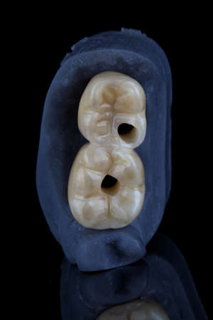 beautiful ceramic crowns top view on the model, shown on a black background