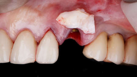 soft tissue flap on the gums for gum volumeの写真素材