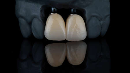 crowns of central incisors on a dental model, filmed on black glass with reflection