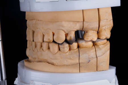 model for biting ceramic inlays on chewing teeth