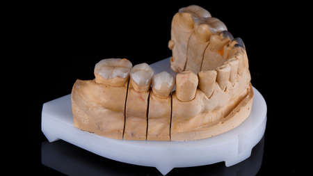 jaw model and five ceramic ultra-thin tabs