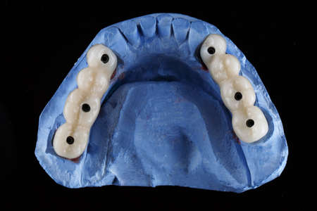 blue dental model and temporary dentures on the chewing teeth on a black background
