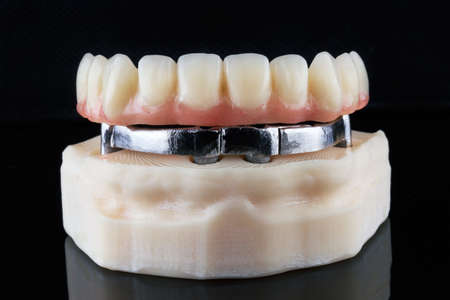 titanium beam for dental prosthetics and high quality prosthesis with artificial gum