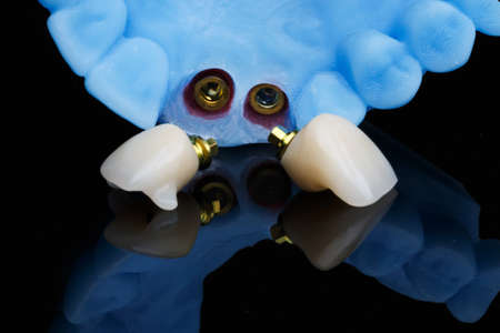dental crown and dental model, shown mount and components on black glass