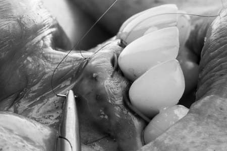 gum closure after implantation and staging of dental crowns, shot in black and white styleの写真素材