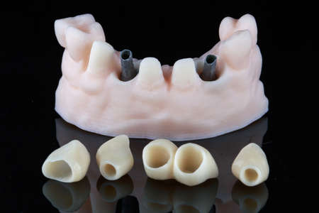 dental model with abutments and crowns next to it for subsequent insertion of the installation