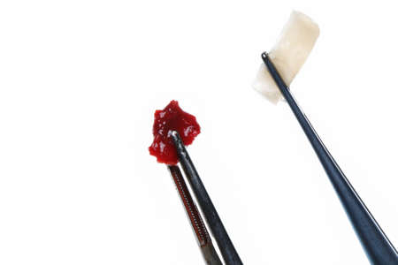 soft tissue for implantation and gum volume during dental surgeryの写真素材