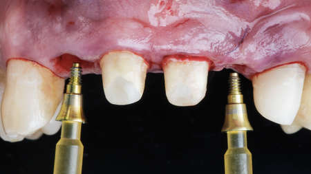 installation of implant components and dental crowns