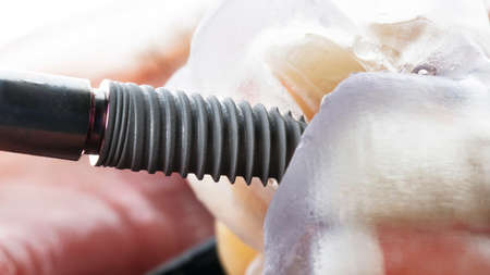 beautiful photo of a dental implant of medium size and a surgical template during surgeryの写真素材