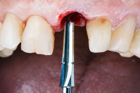 special dental cutter-drill to prepare the bone for implantation